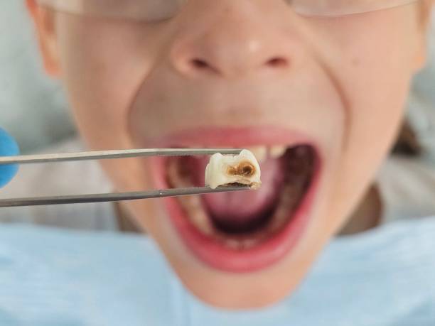 Teeth Whitening in MN